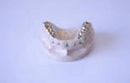 コーヌス義歯2