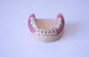 コーヌス義歯4