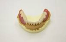コーヌス義歯7