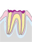 虫歯を取り、根の治療をする