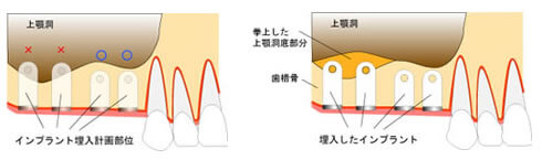 ボーングラフト