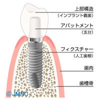 インプラントとはどのようなもの？