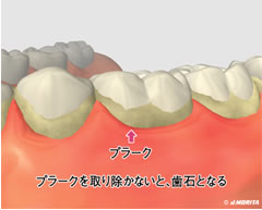 歯周病とはどんな病気？