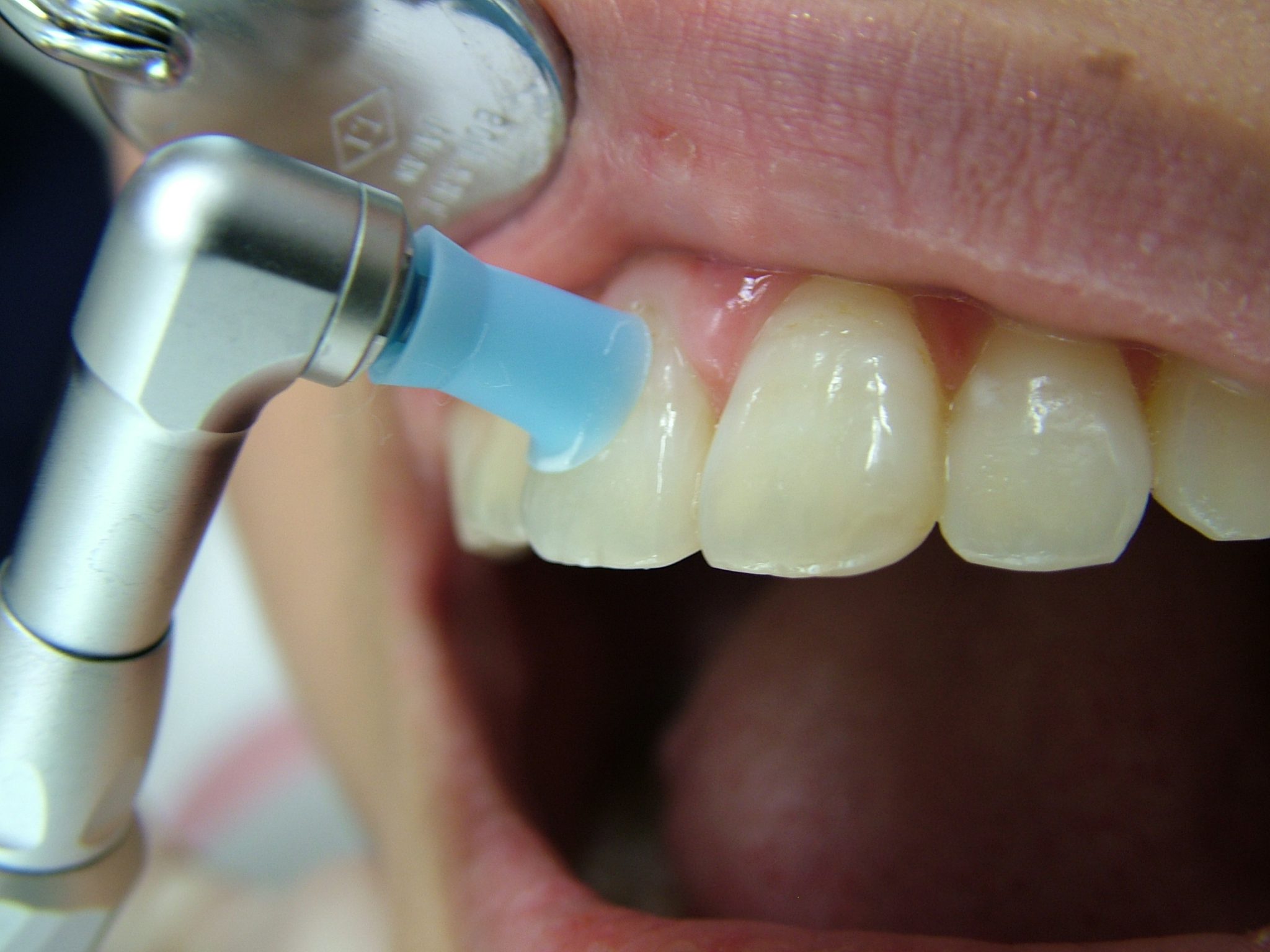 歯 の クリーニング 保険 適用 外